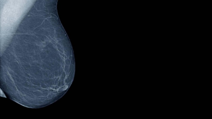 Para ilmuwan mengubah sel kanker payudara menjadi lemak dan mencegahnya menyebar 3
